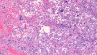 Primary CNS Histiocytic Sarcoma - Neuropathology, Columbia University Pathology and Cell Biology Primary CNS Histiocytic Sarcoma - Neuropathology, Columbia University Pathology and Cell Biology